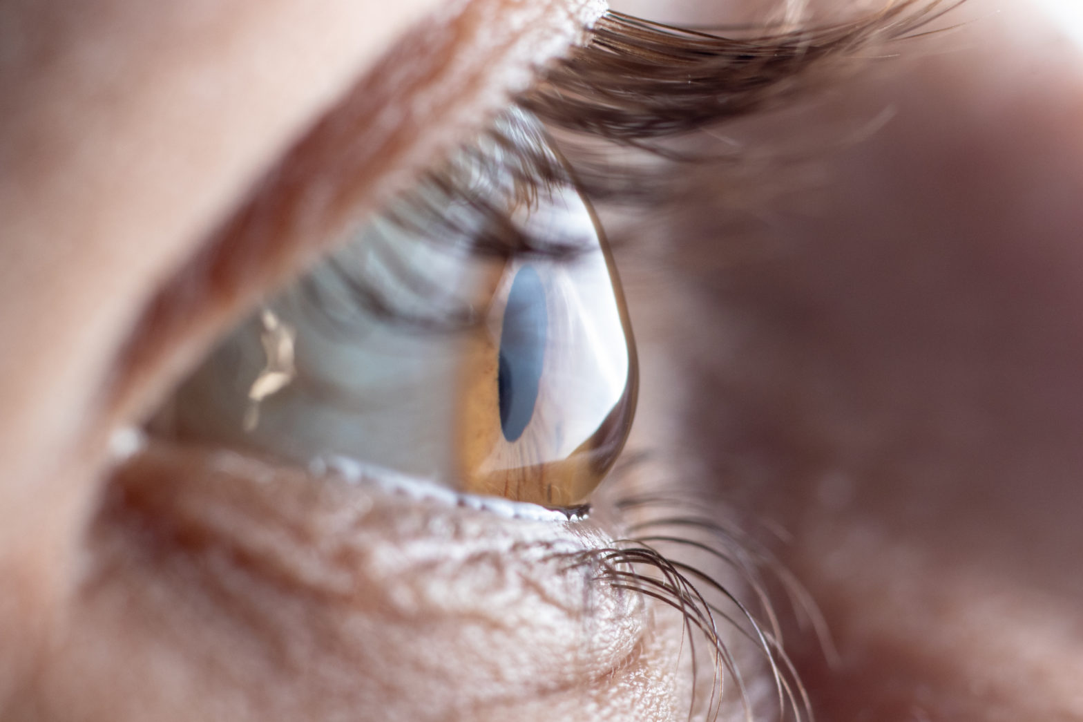 What is Keratoconus: Diagnosis and Treatment