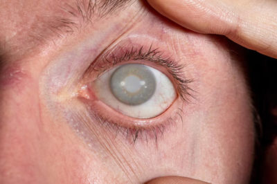 Different Stages of Cataracts
