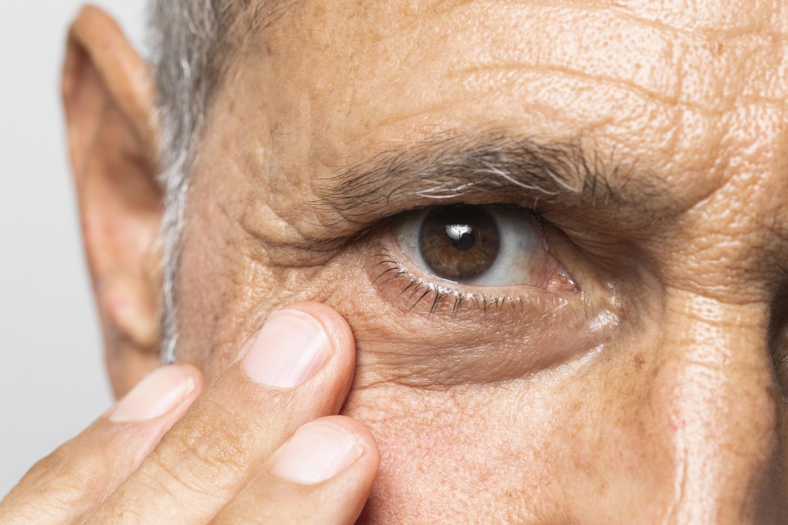 How to Remove Cholesterol Deposits Around Eyes Naturally: Tips and Treatments