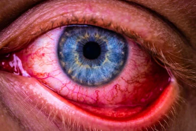 Eye Flu