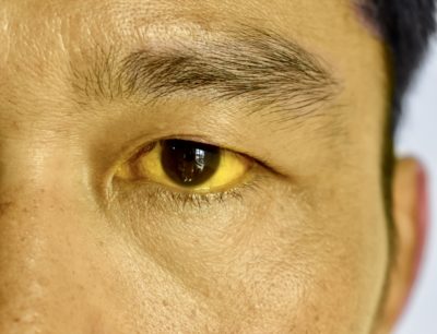 Scleral Icterus