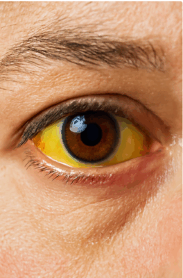 Scleral Icterus-1
