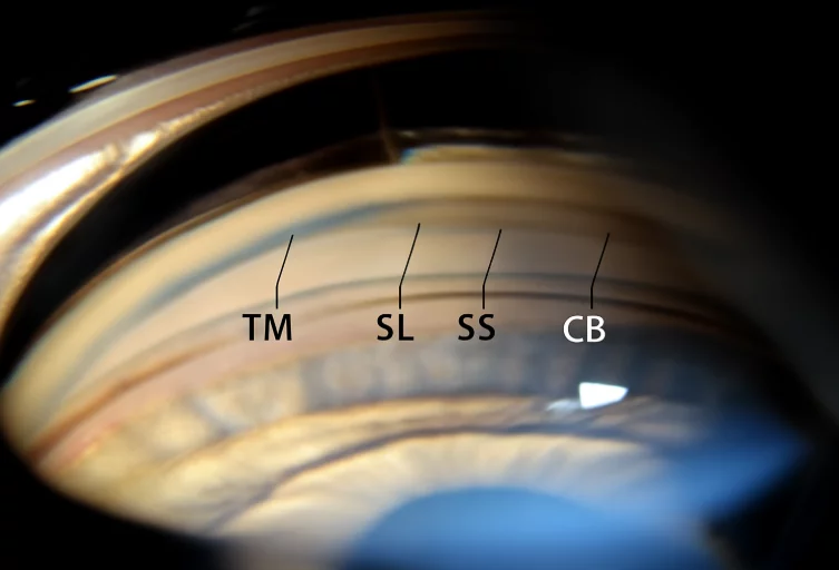 Gonioscopy: What It Is, Procedure, Types & Benefits for Eye Health