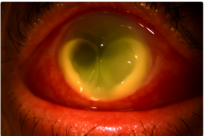 Panophthalmitis – Causes, Symptoms, Diagnosis & Treatment Options