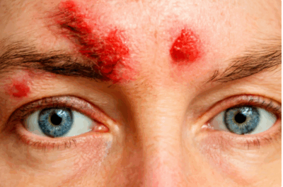 shingles in the eye