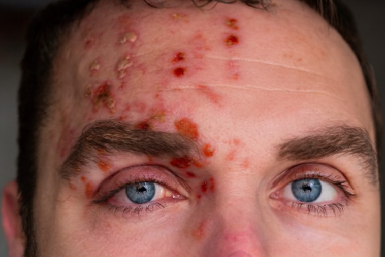 Shingles in the Eye: What It Is, How It Works, and Who Should Seek Care