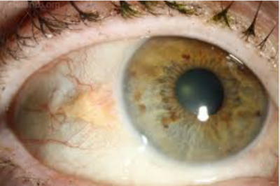 Pinguecula Eye