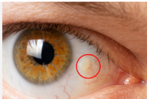 Pinguecula Eye