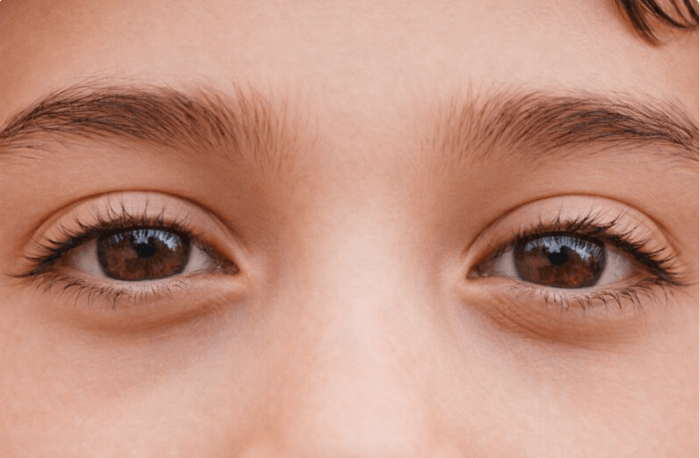 Asymmetrical Eyes: Causes, Treatment Options & How to Fix Them