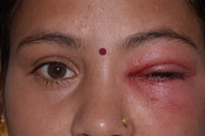 Dacryocystitis Treatment