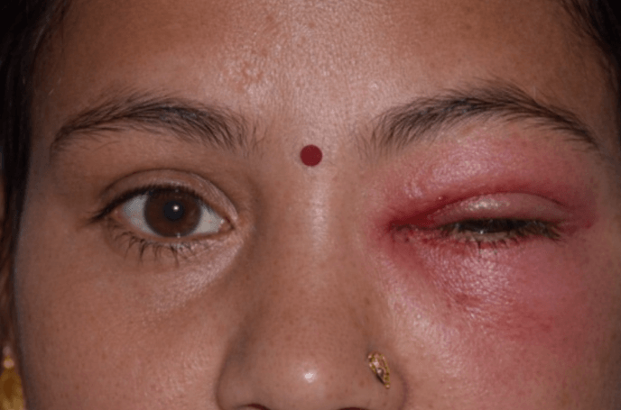 Dacryocystitis Treatment: Causes, Symptoms, and the Best Ways to Treat It