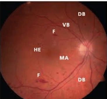 Dot and Blot Hemorrhages