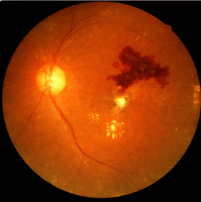 Retinal Hemorrhage