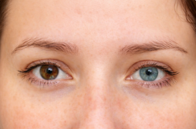 heterochromia