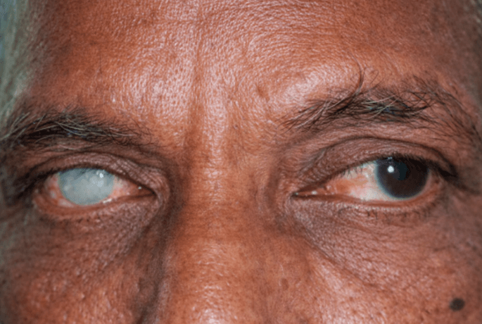 कॉर्नियल ब्लाइंडनेस क्या है? कॉर्निया को हुए नुकसान से दृष्टि कैसे प्रभावित होती है, इसे समझना।