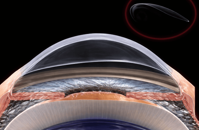 What Is Epi LASIK? The Safe Vision Correction for Thin Corneas