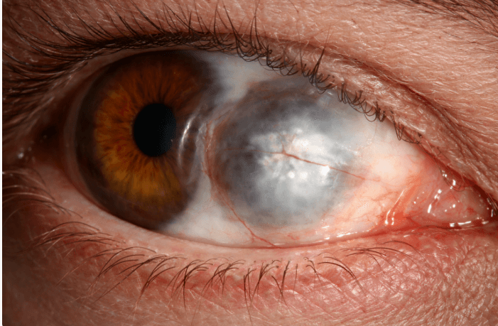 What Is Staphyloma? A Complete Guide to Types, Diagnosis, and Eye Health Risks