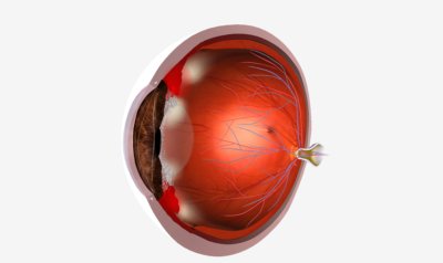 Keratoconus Myths and Facts