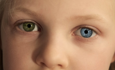Heterochromia Eyes