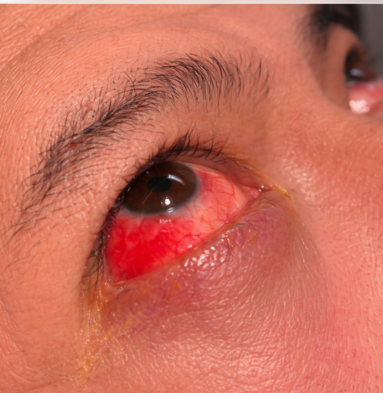 Bulbar Conjunctiva