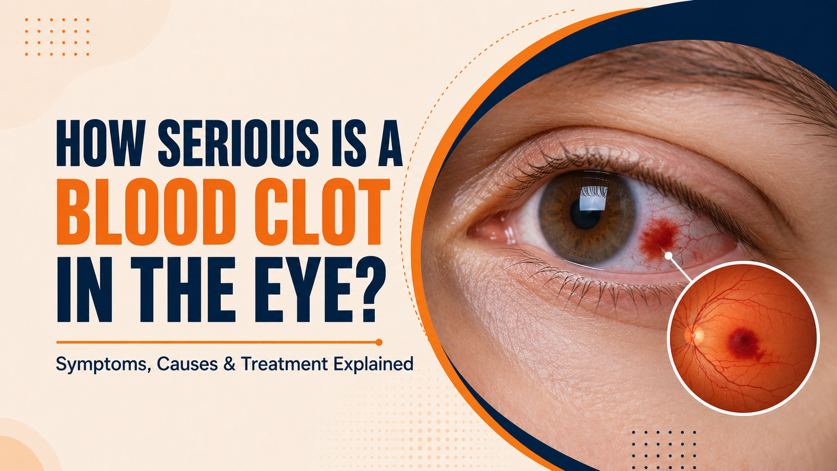 Blood Clot in the Eye