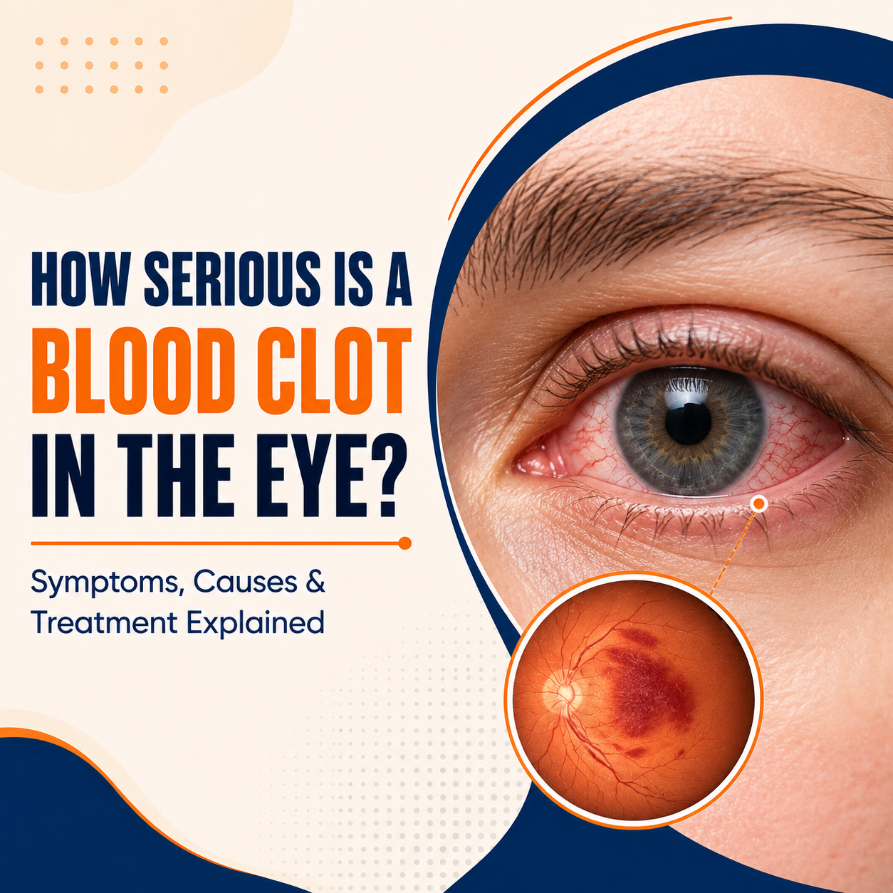 Blood Clot in the Eye