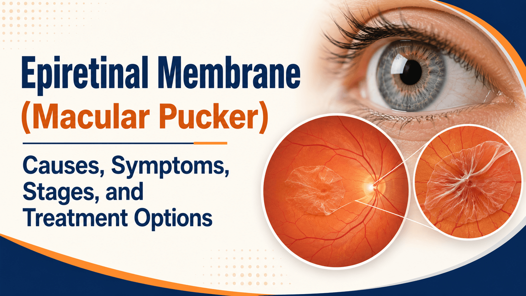 Epiretinal Membrane (Macular Pucker)
